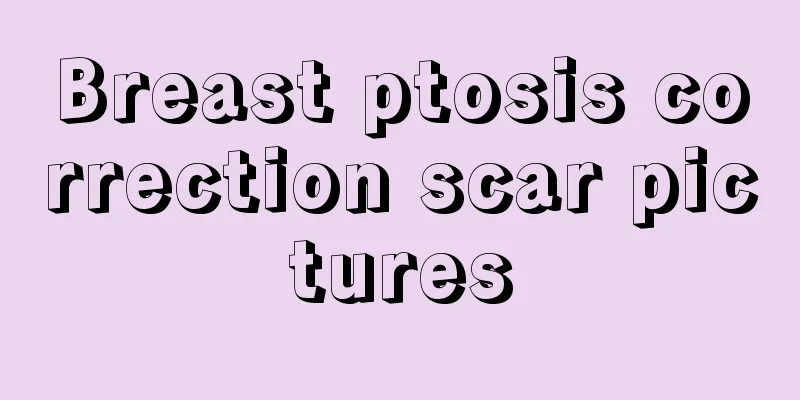 Breast ptosis correction scar pictures