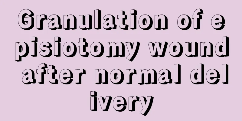 Granulation of episiotomy wound after normal delivery