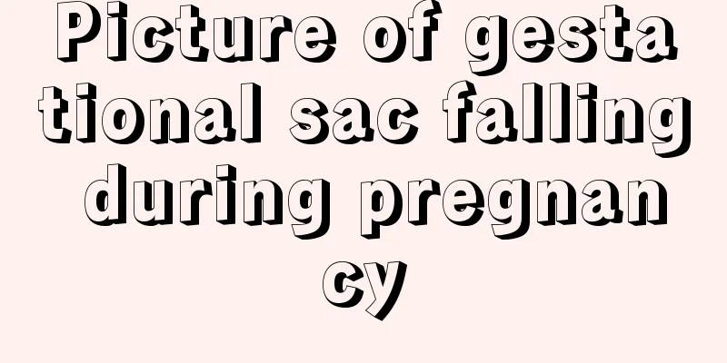 Picture of gestational sac falling during pregnancy