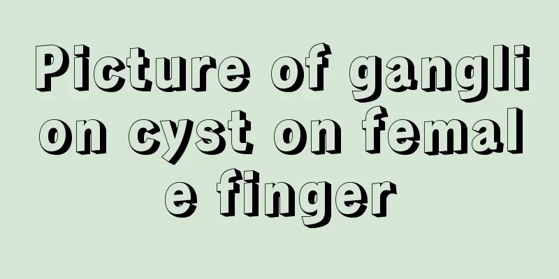 Picture of ganglion cyst on female finger