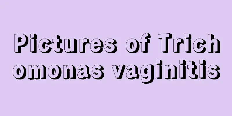 Pictures of Trichomonas vaginitis