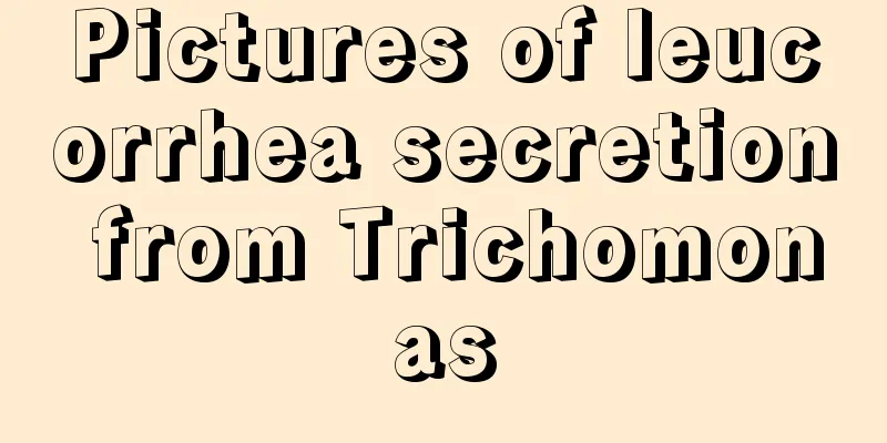 Pictures of leucorrhea secretion from Trichomonas