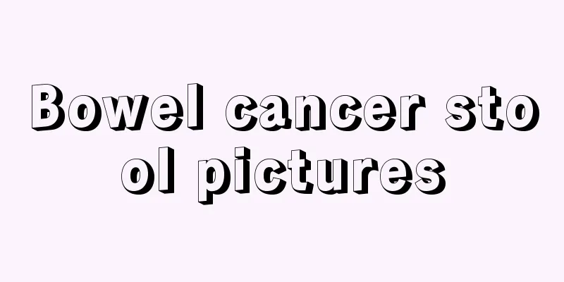 Bowel cancer stool pictures