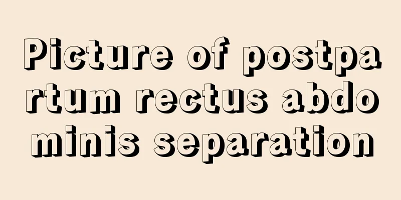 Picture of postpartum rectus abdominis separation