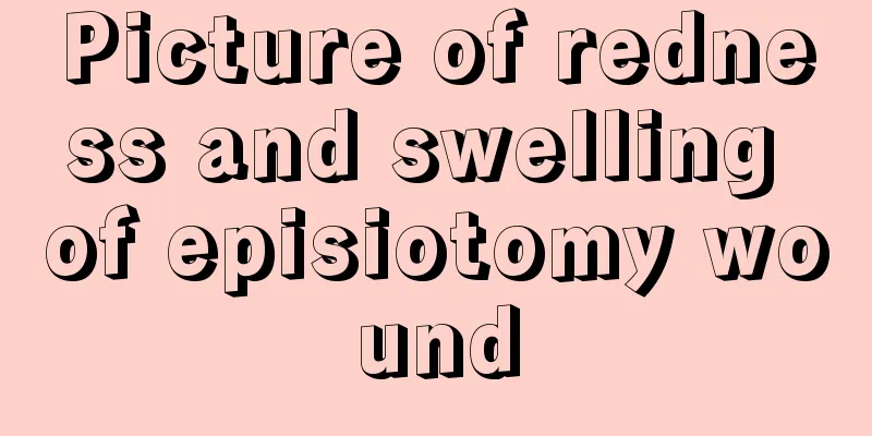 Picture of redness and swelling of episiotomy wound