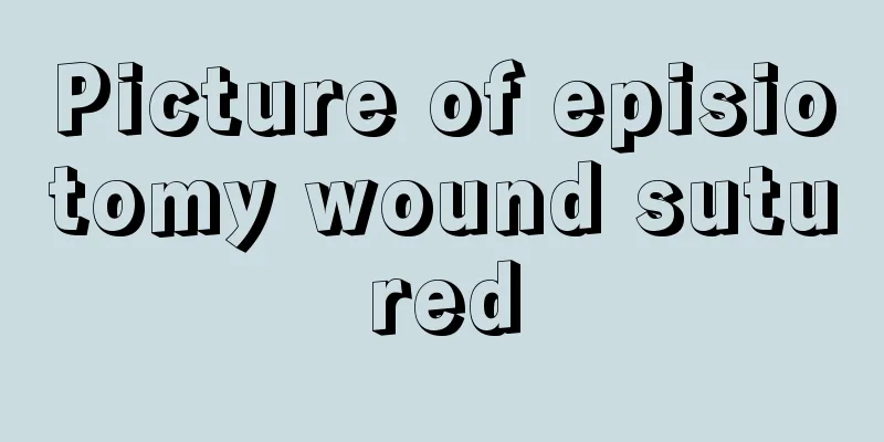 Picture of episiotomy wound sutured