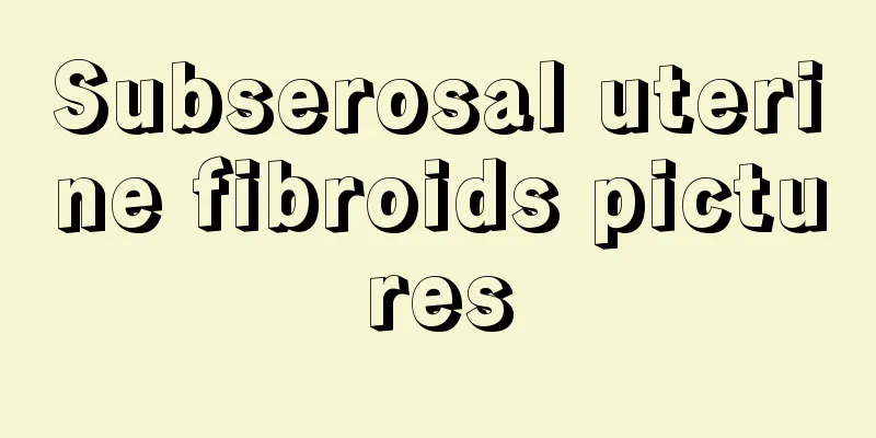 Subserosal uterine fibroids pictures