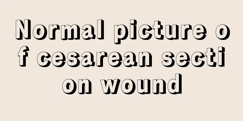 Normal picture of cesarean section wound