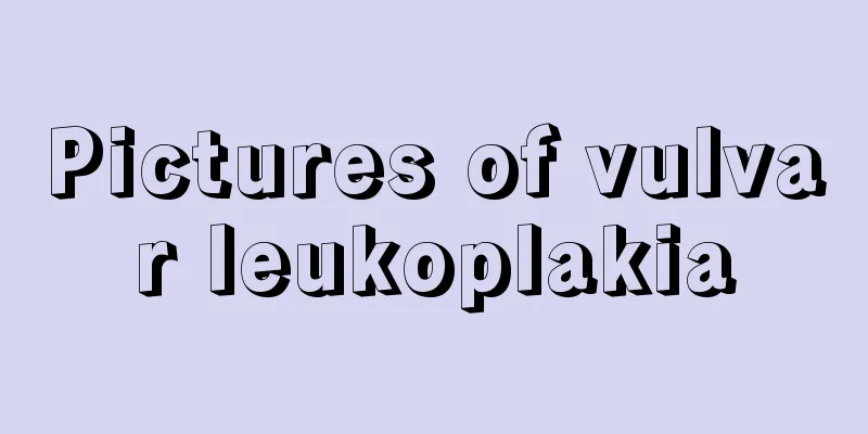 Pictures of vulvar leukoplakia