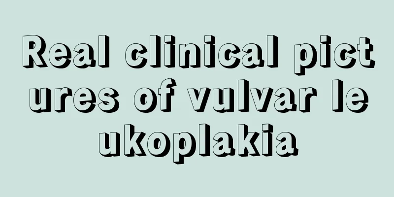 Real clinical pictures of vulvar leukoplakia