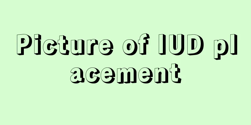 Picture of IUD placement