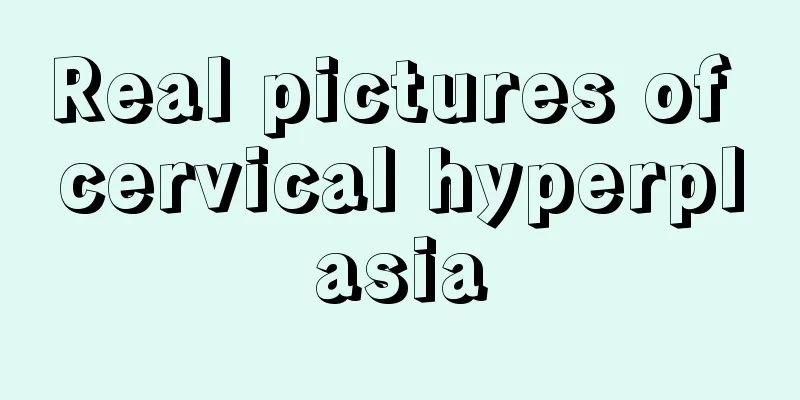 Real pictures of cervical hyperplasia