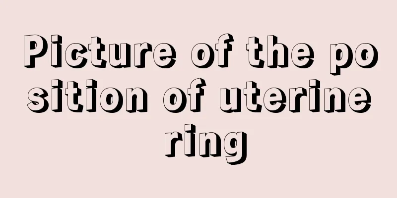 Picture of the position of uterine ring