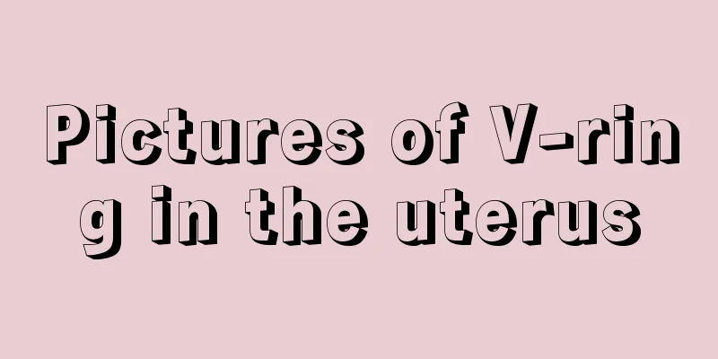 Pictures of V-ring in the uterus