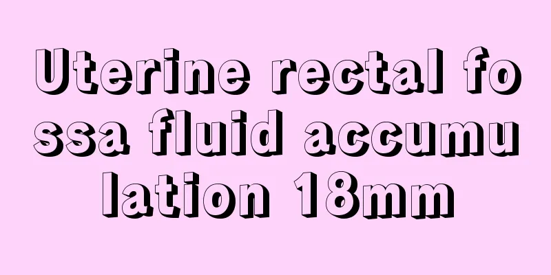 Uterine rectal fossa fluid accumulation 18mm