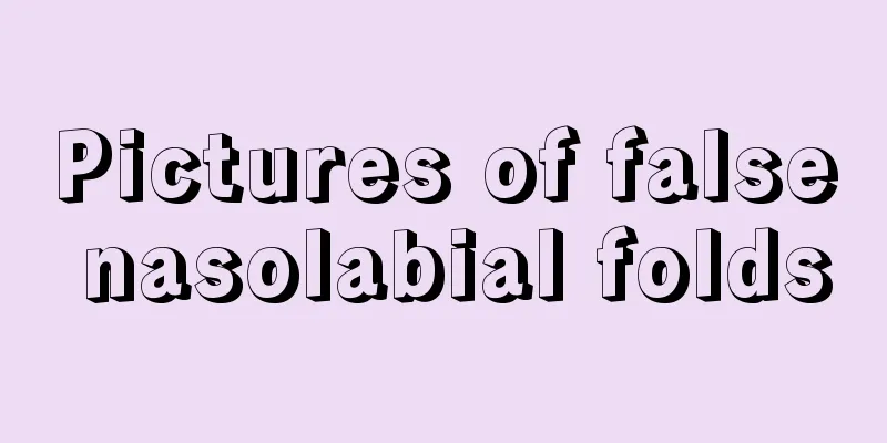 Pictures of false nasolabial folds