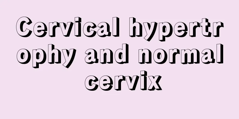 Cervical hypertrophy and normal cervix