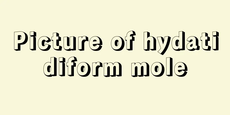 Picture of hydatidiform mole