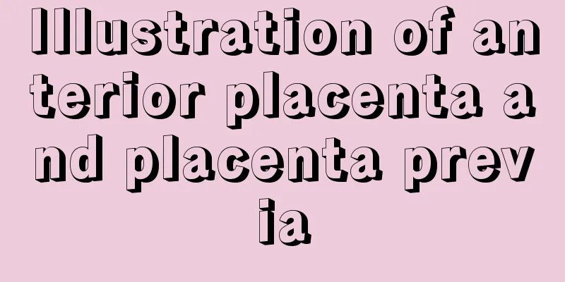 Illustration of anterior placenta and placenta previa