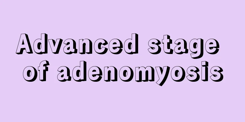 Advanced stage of adenomyosis