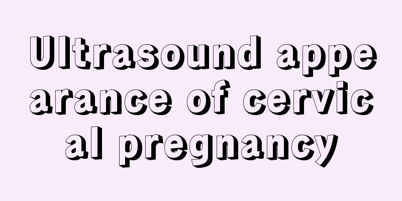 Ultrasound appearance of cervical pregnancy