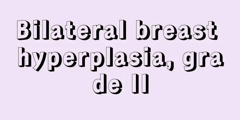 Bilateral breast hyperplasia, grade II