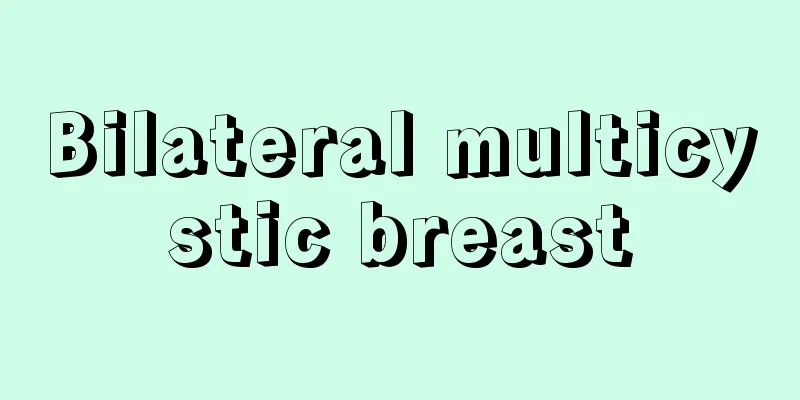 Bilateral multicystic breast