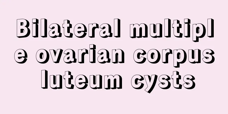 Bilateral multiple ovarian corpus luteum cysts