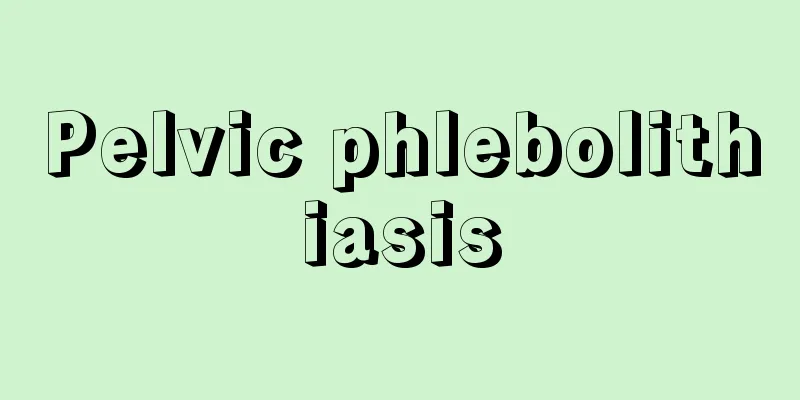 Pelvic phlebolithiasis