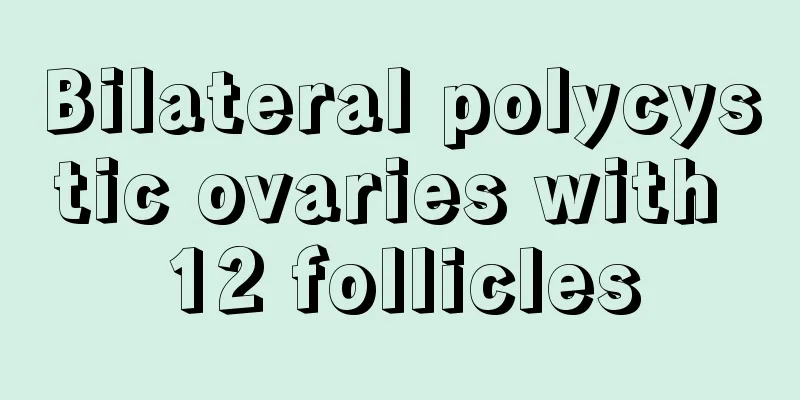 Bilateral polycystic ovaries with 12 follicles