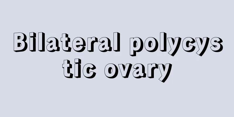 Bilateral polycystic ovary