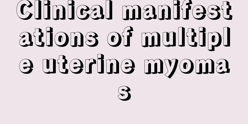 Clinical manifestations of multiple uterine myomas