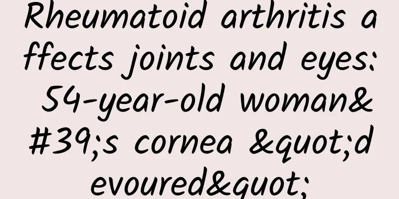 Rheumatoid arthritis affects joints and eyes: 54-year-old woman's cornea "devoured"