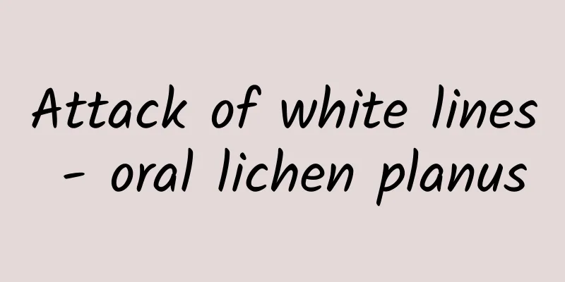 Attack of white lines - oral lichen planus